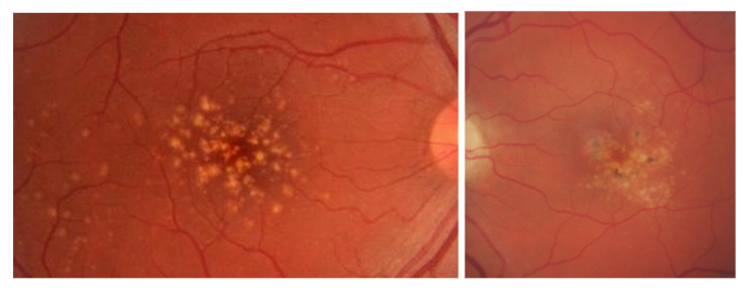 Miopía patológica: Tipos de miopía