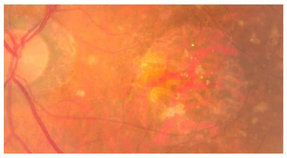 Miopía patológica: Tipos de miopía