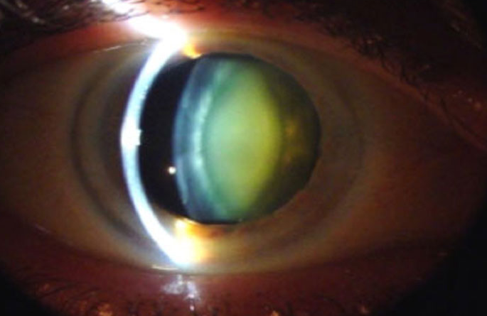 Miopía patológica: Tipos de miopía