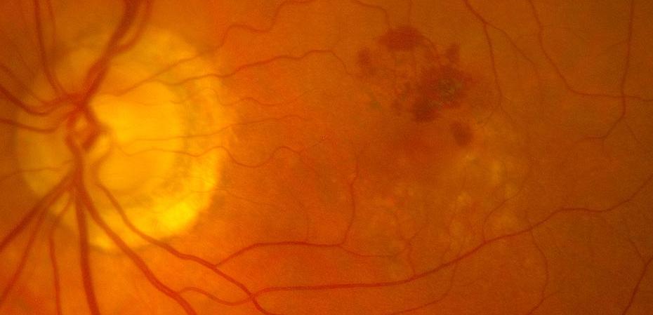 Miopía patológica: Tipos de miopía